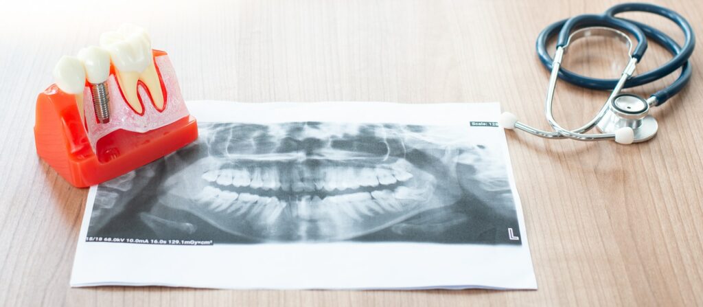 Dental implant model in dental office.